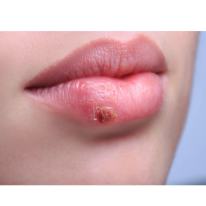 Cold sore